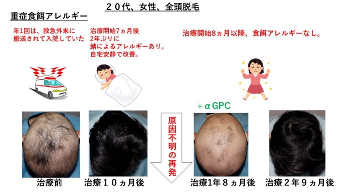 円形脱毛症　病院